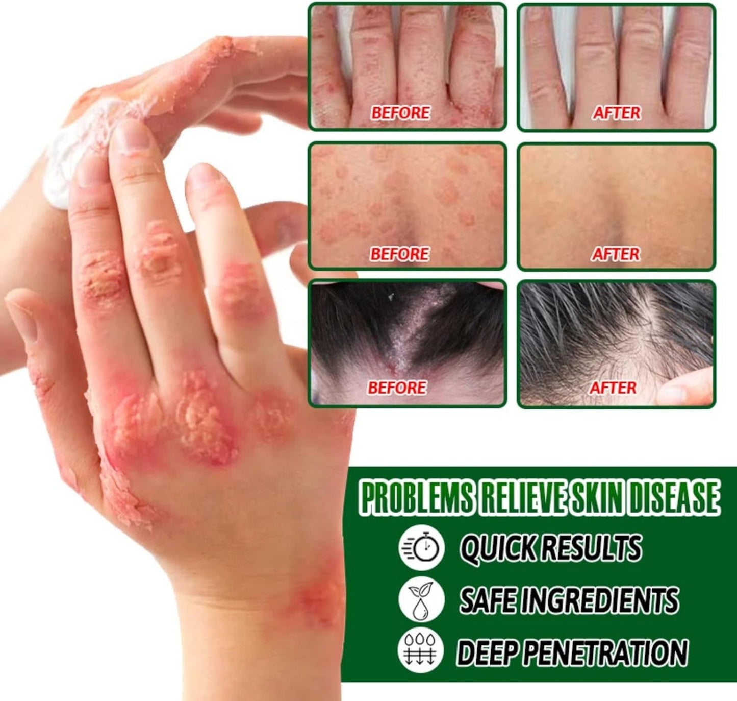 Psoriasis Cream (Original) – 20g (Pack of 2)