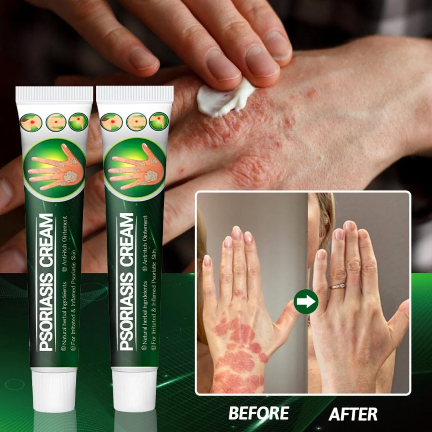 Psoriasis Cream (Original) – 20g (Pack of 2)