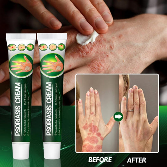 Psoriasis Cream (Original) – 20g (Pack of 2)