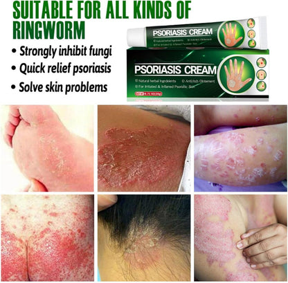Psoriasis Cream (Original) – 20g (Pack of 2)